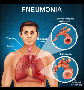 pneumonia-symptoms-riskfactors-prevention