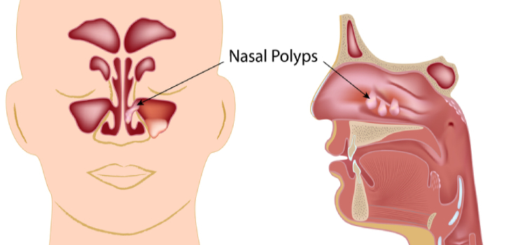 Nasal corticosteroids