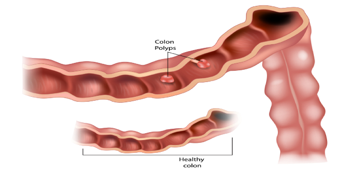 colon in intestine