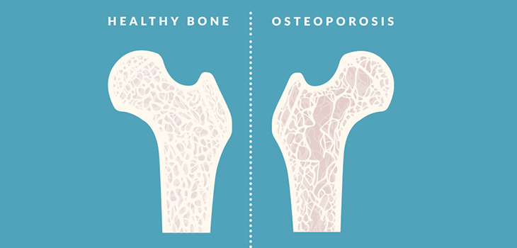 osteoarthritis knee symptoms