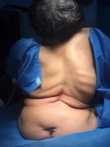 Patients's after opertaion