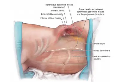 laparoscopic-etep-rives-stoppa-1