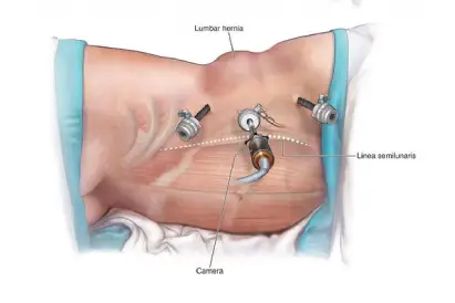 Laparoscopic eTEP Rives-Stoppa