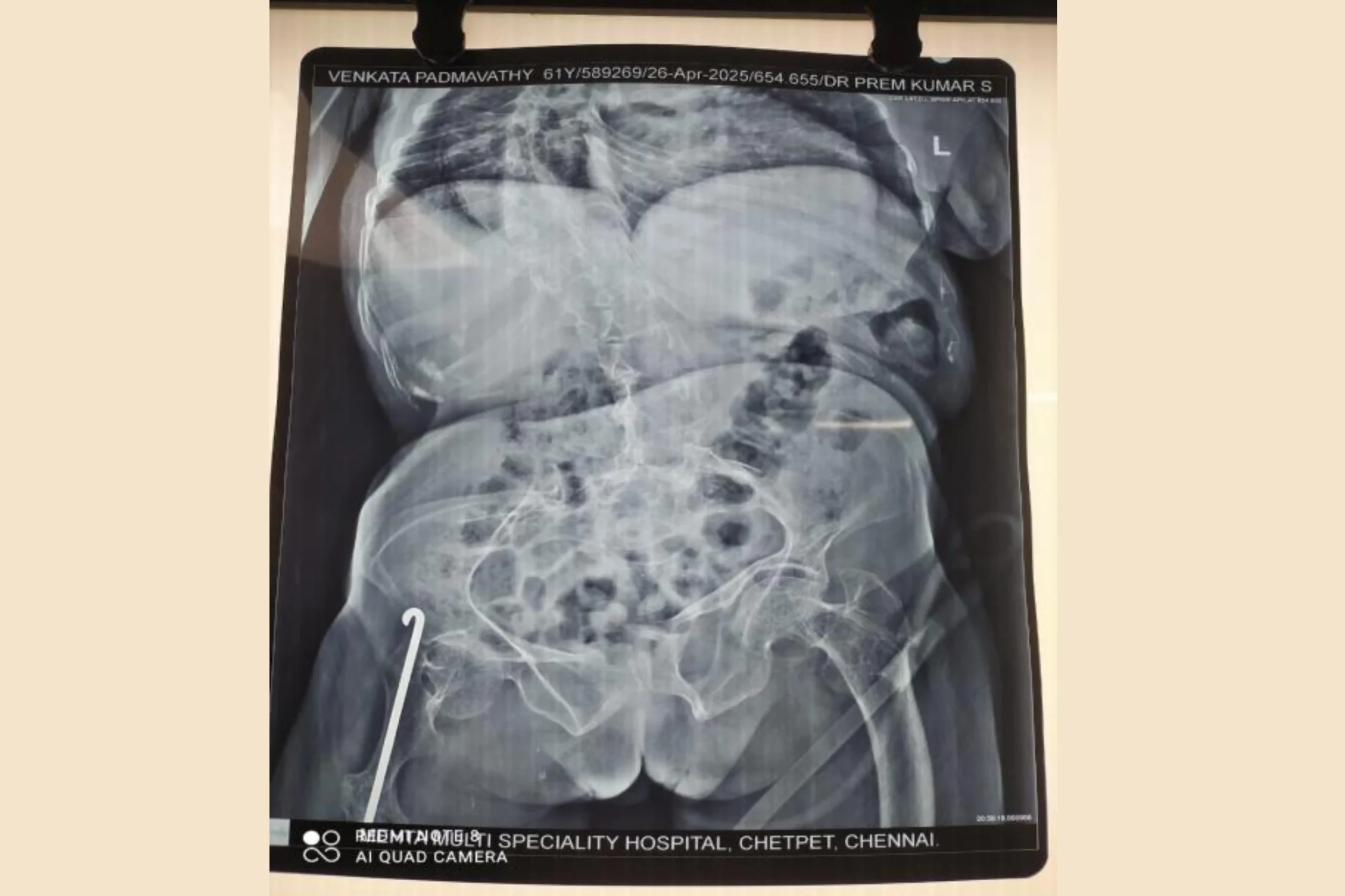 Osteogenesis imperfecta (OI) is an inherited disease