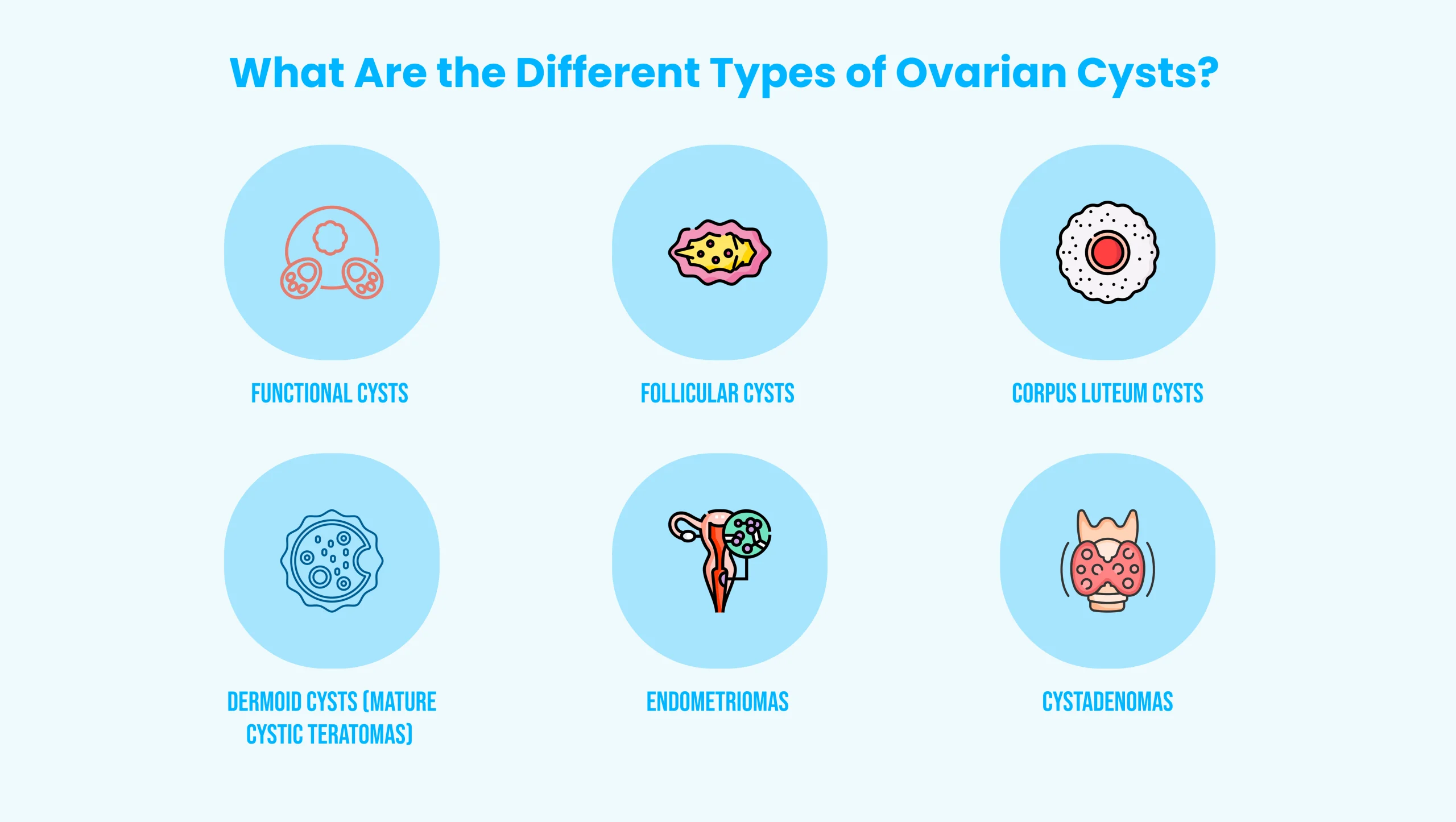Illustration showing different types of ovarian cysts in women, including functional cysts, follicular cysts, corpus luteum cysts, dermoid cysts, endometriomas, and cystadenomas.