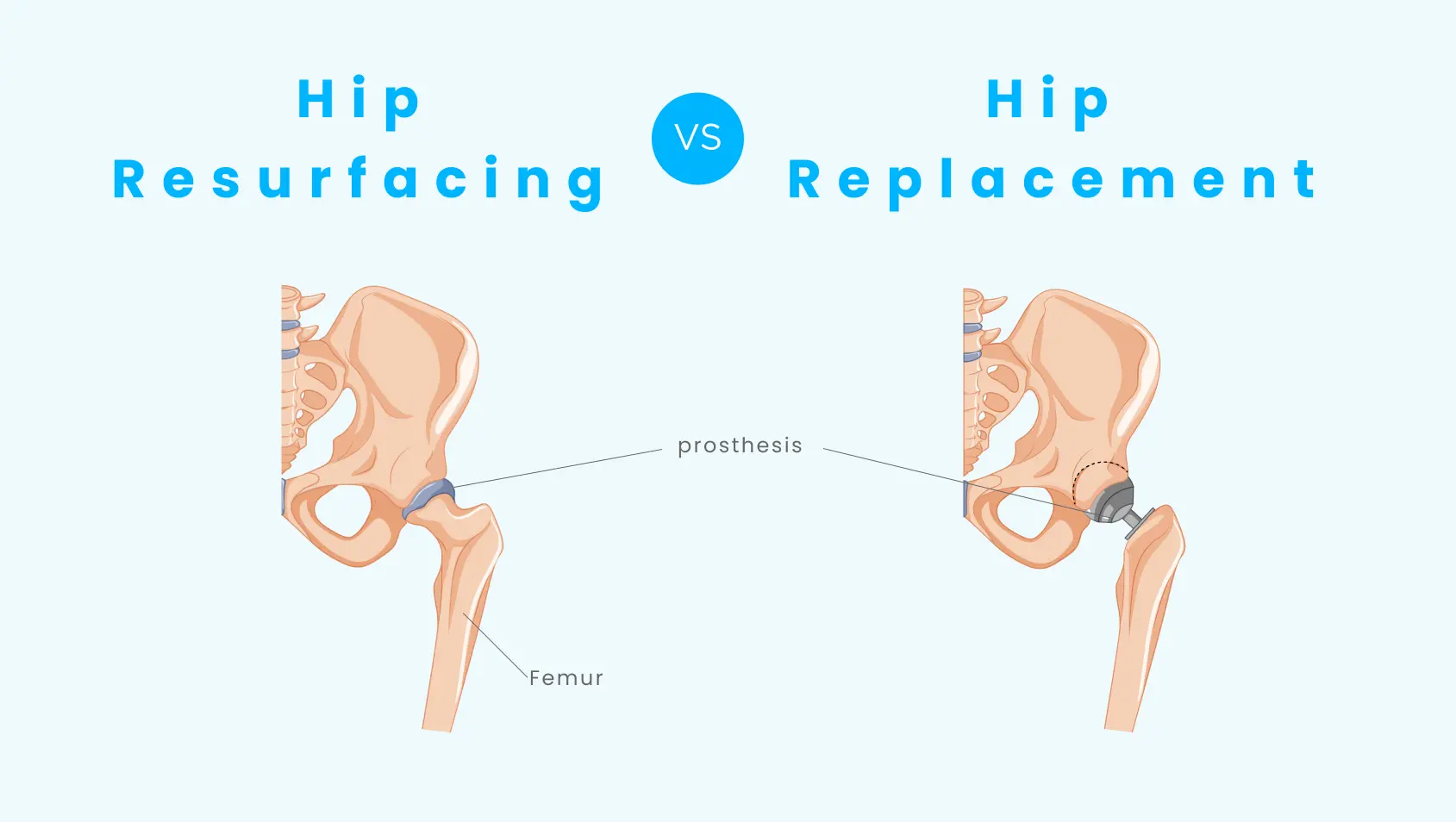 difference between hip resurfacing and hip replacement