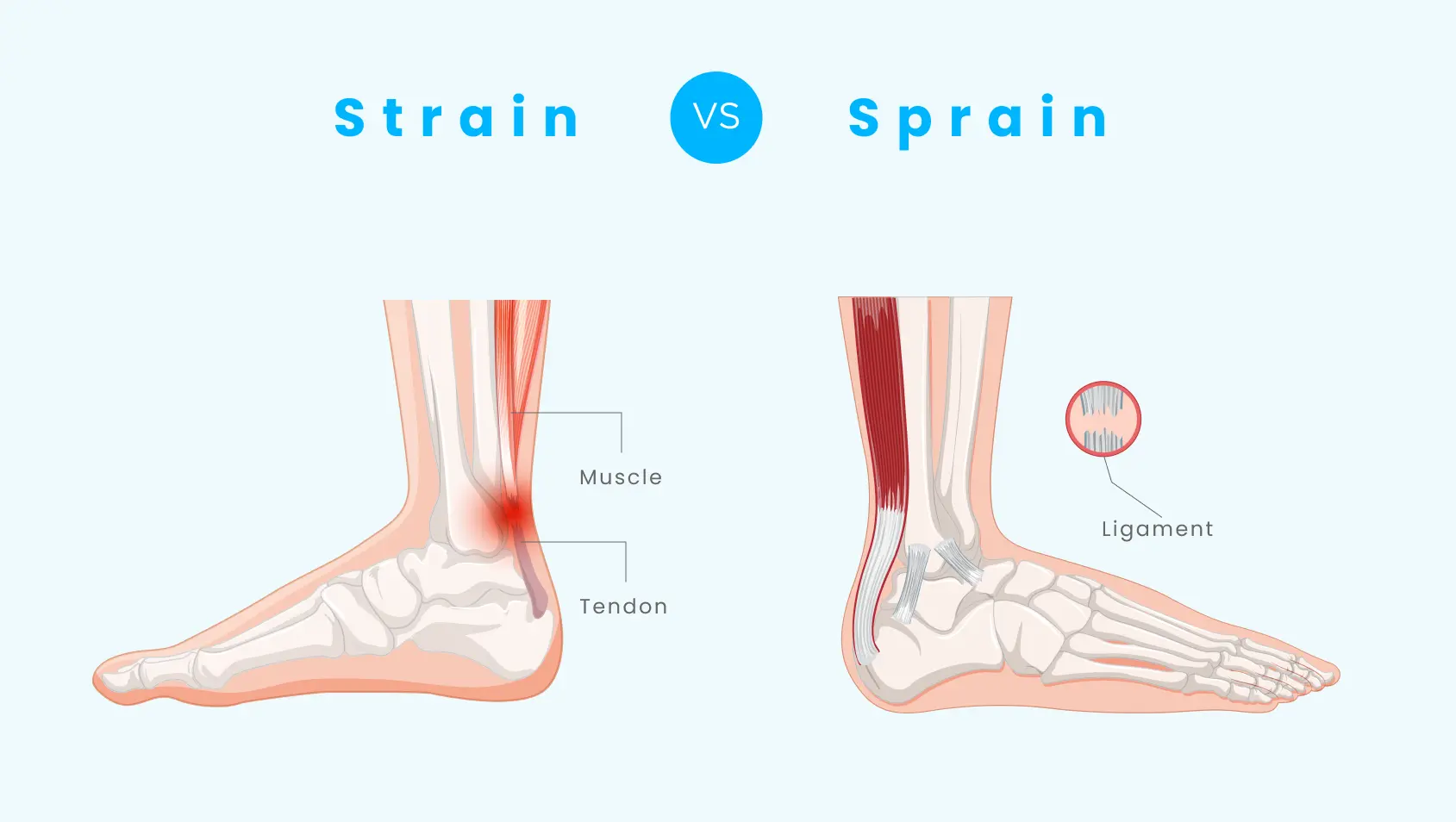 sprain vs strain