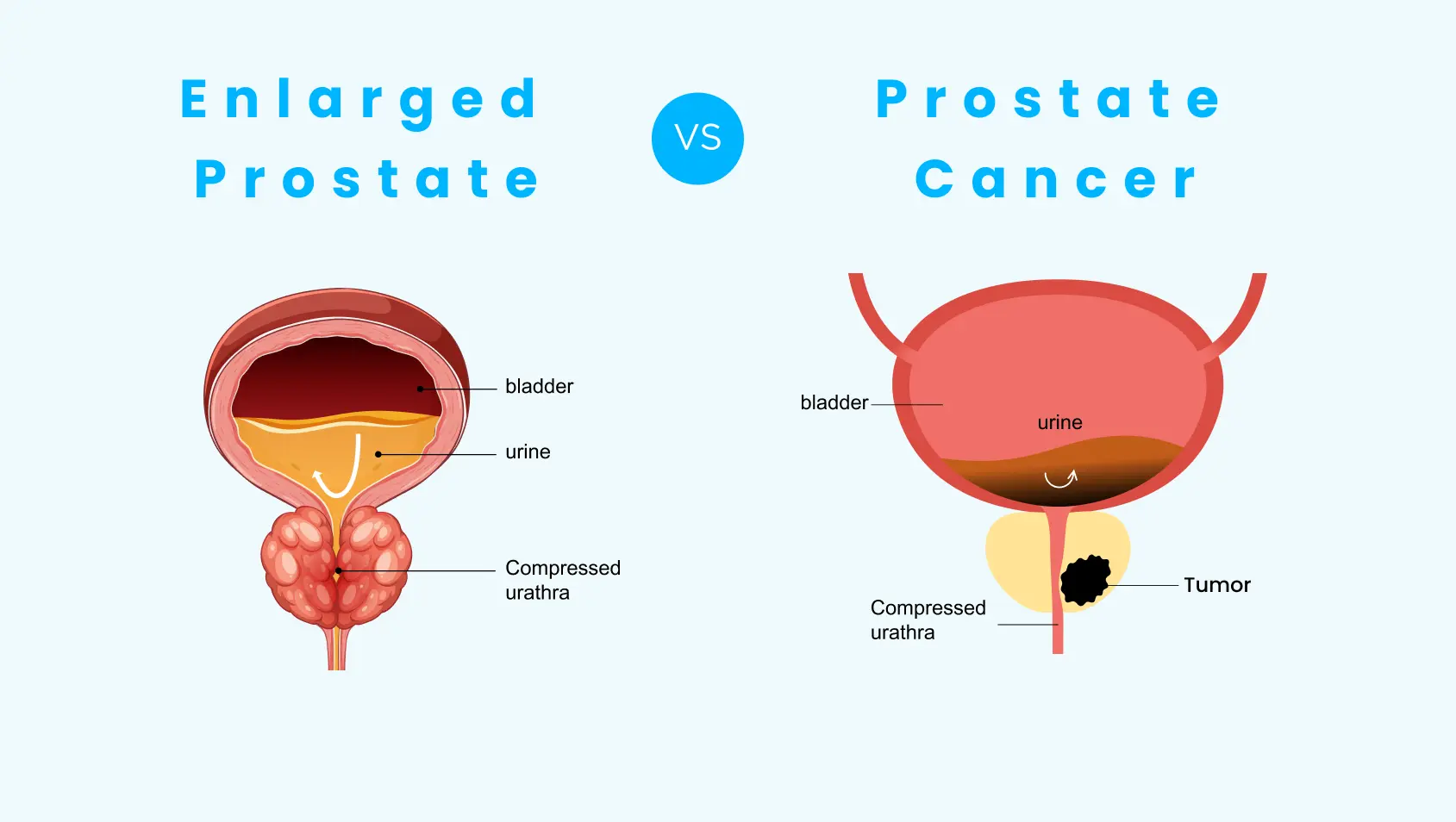 Enlarged Prostate vs Prostate Cancer