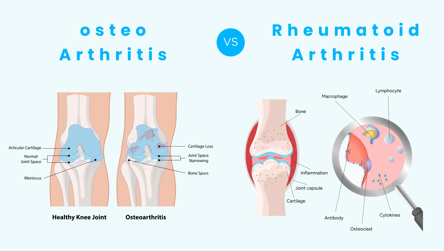 osteo arthritis vs rheumatoid Arthritis